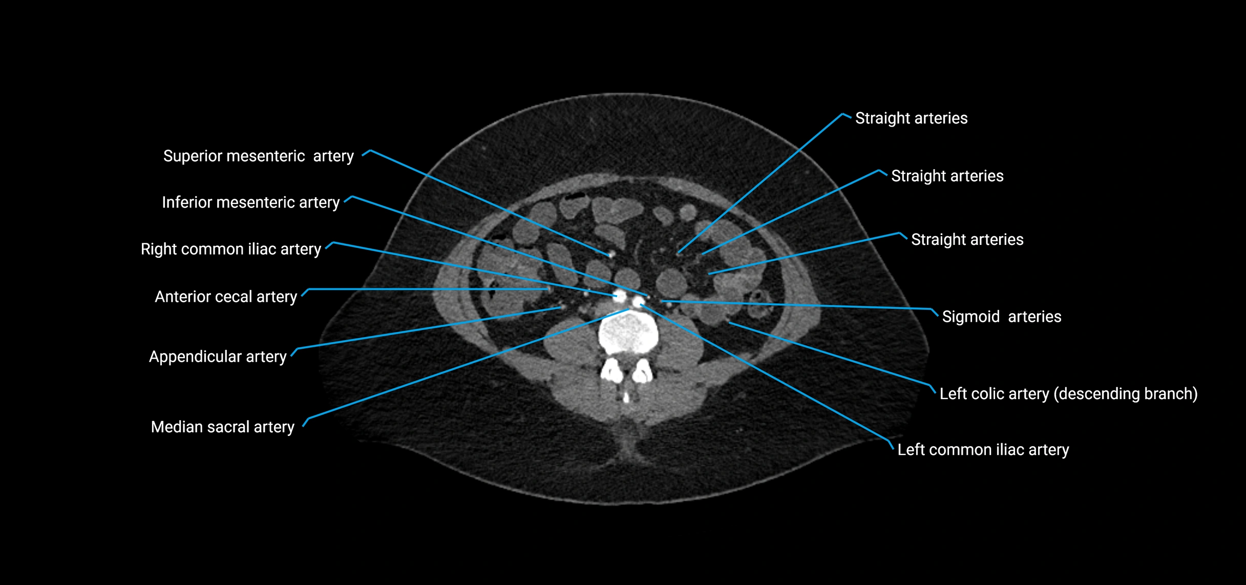 CTA abdomen axial cross sectional anatomy labelled image_133 (2).webp